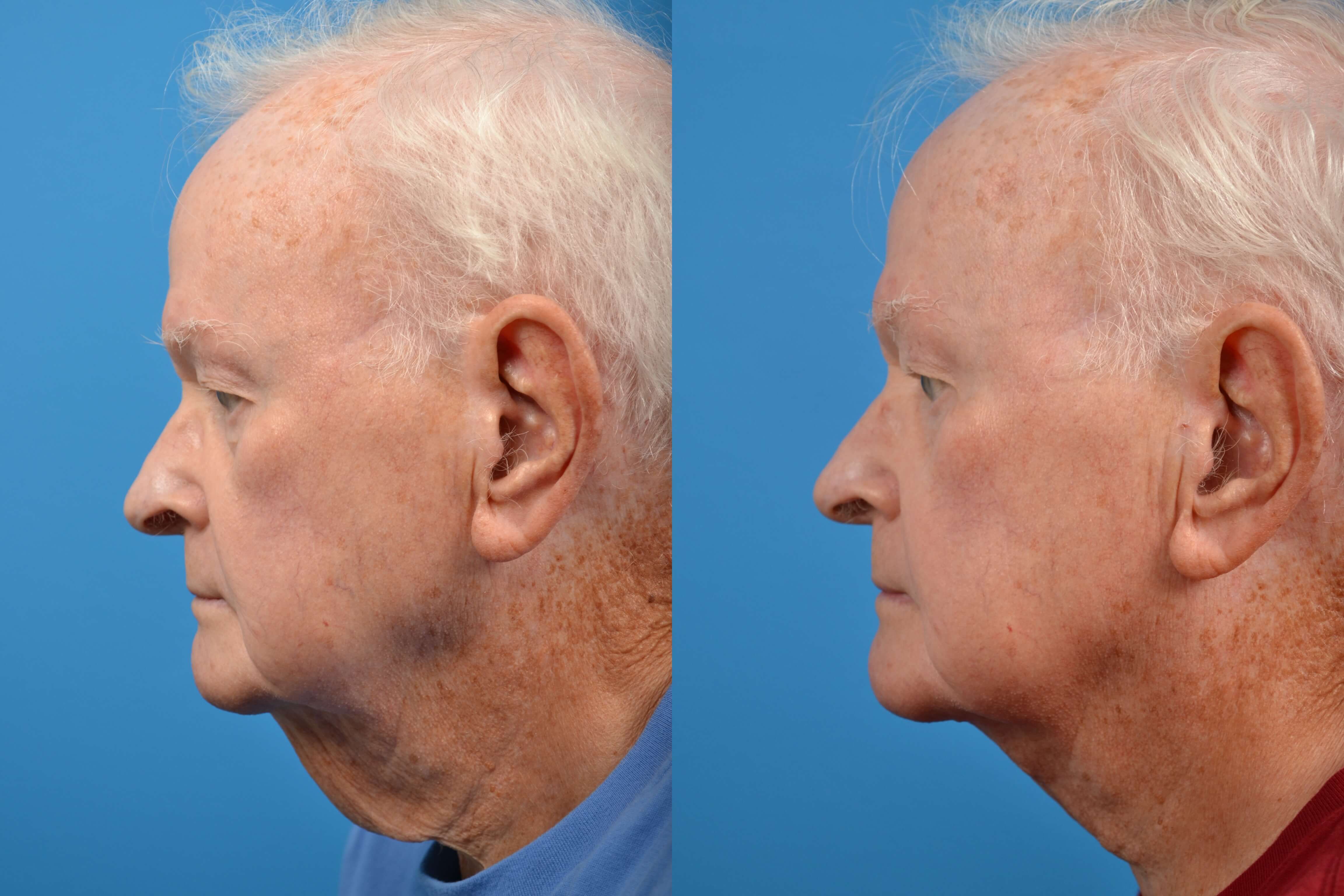 Profile Neck Lift Photos Melbourne FL Patient 28316   28316 Lateral Left 